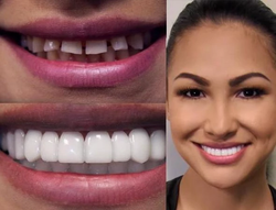 Fake Teeth - Snap-On Smile - Fake Teeth Veneers